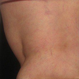 image_of_reticular_veins_after_treatment