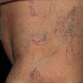 image_of_reticular_veins_before_treatment