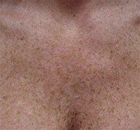 A close up of a person 's chest with a lot of freckles on it.