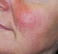 A close up of a woman 's face with red spots on it.
