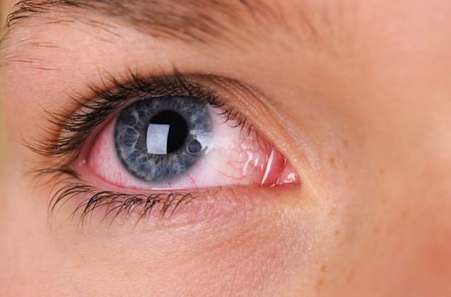 Dry Eyes, Flashes, & Similar Symptoms – Your local Optician can you!