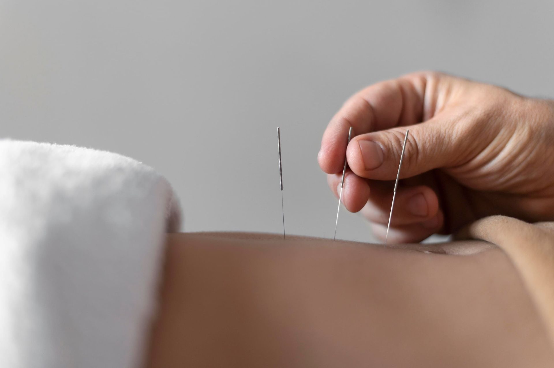 Professional Hand Dry Needling Services for Effective Pain Relief - Yor Physio in Bundaberg, QLD