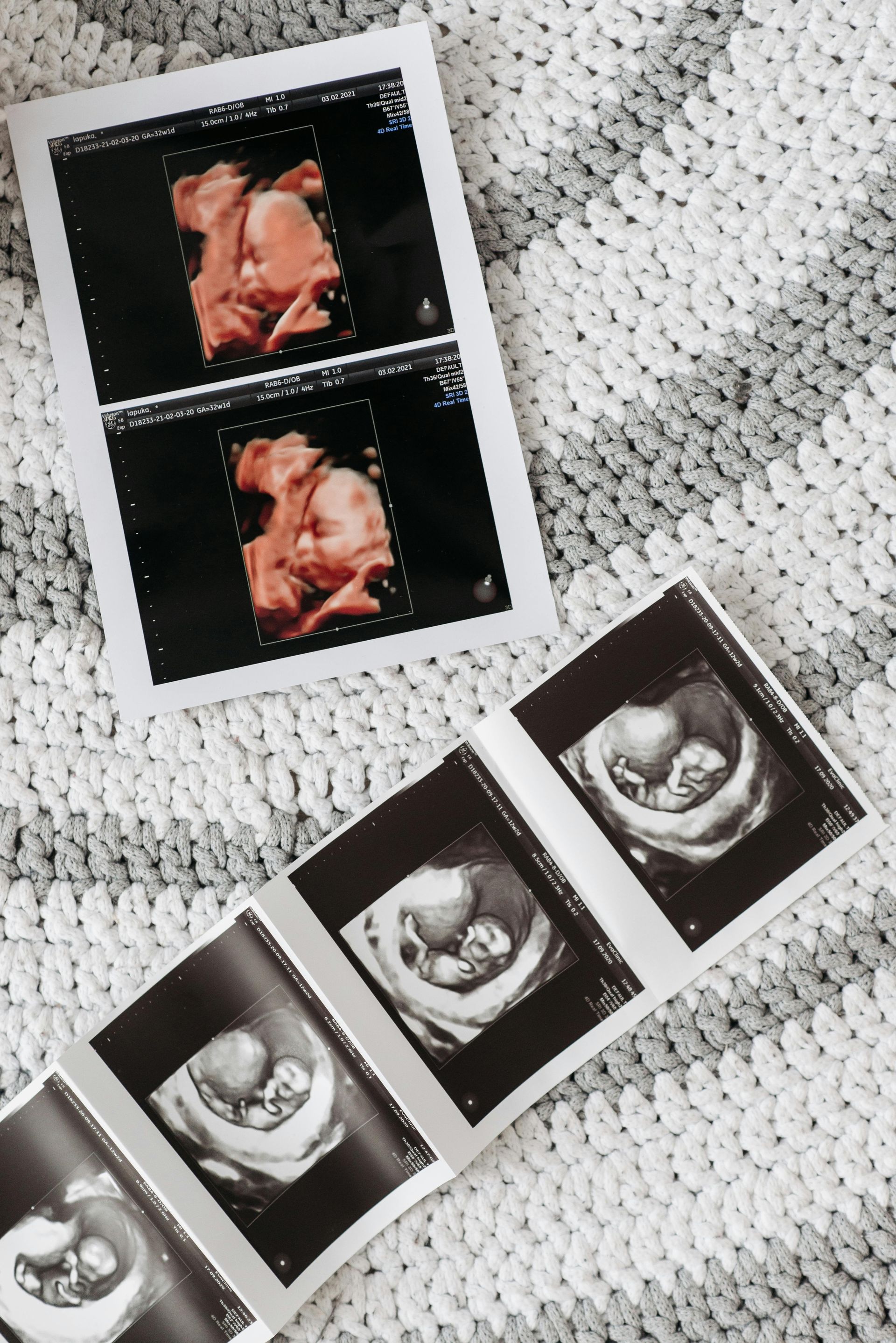 Ultrasound images of a developing baby, in both color and black and white, on a textured blanket.