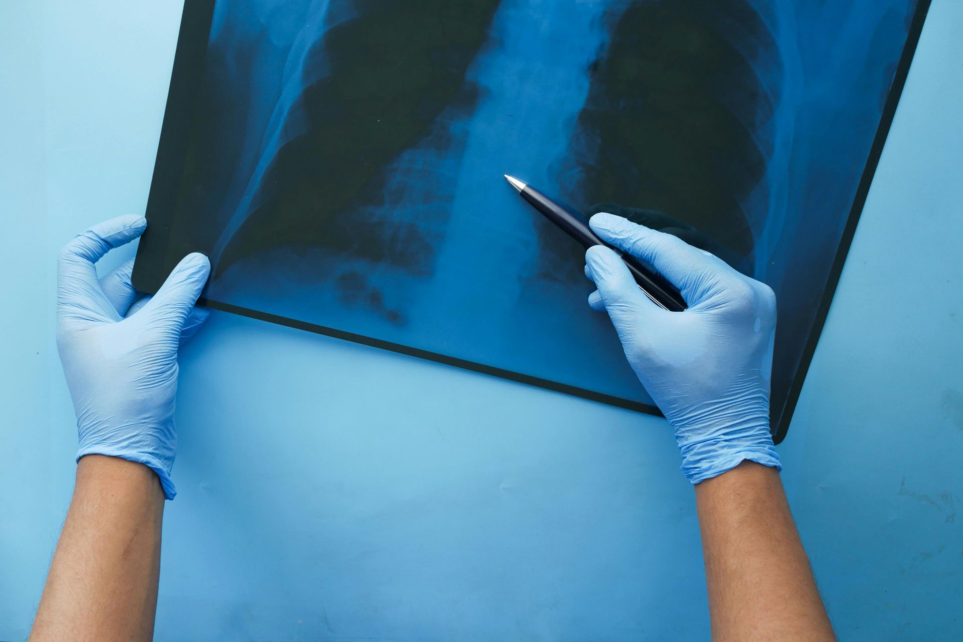 Hands in blue gloves hold and point at a chest X-ray on a blue background.