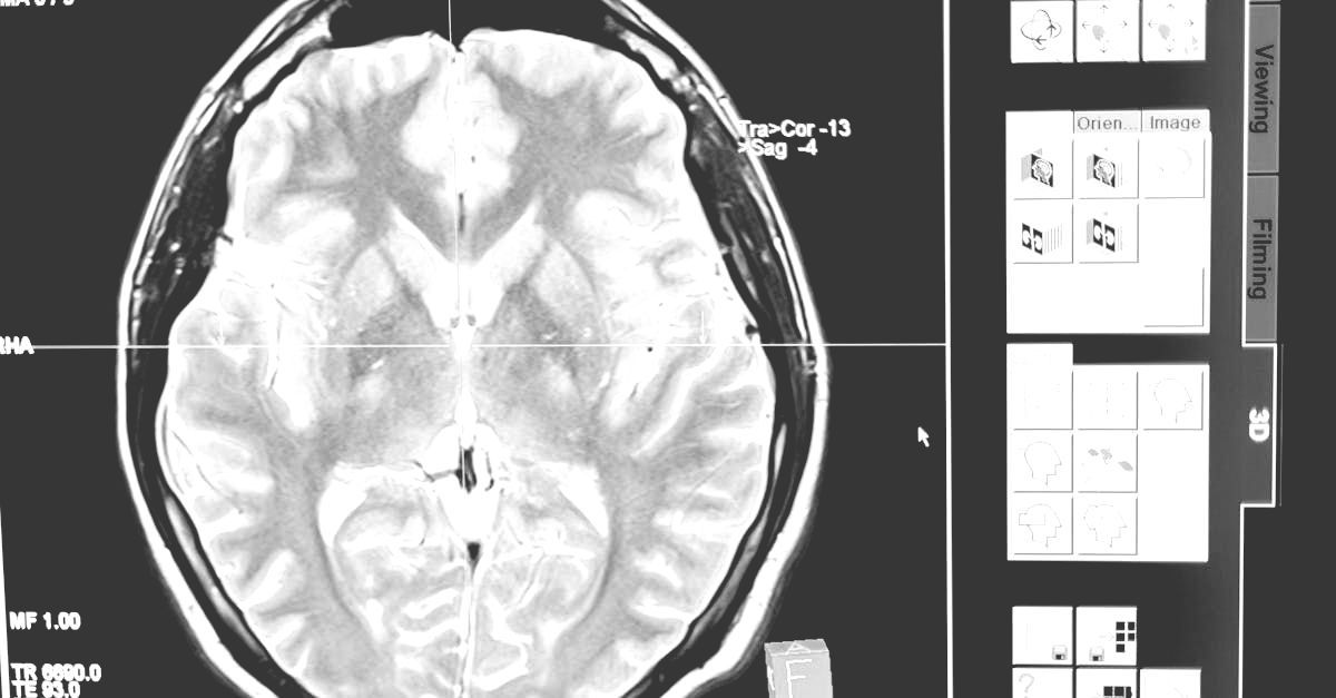 A black and white image of the inside of a human brain
