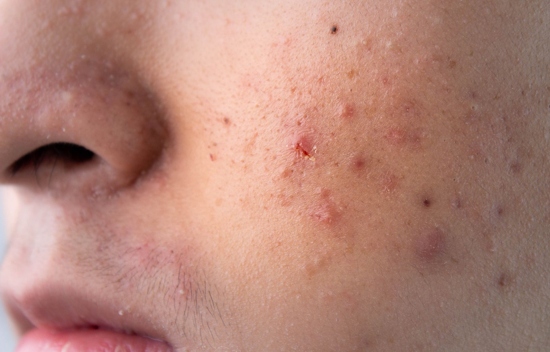 A close up of a person 's face with acne on it.