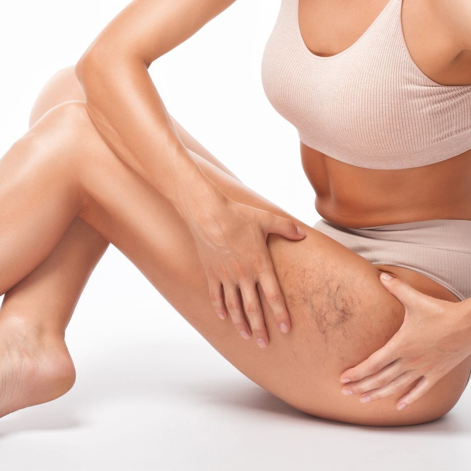 A woman with varicose veins on her legs is sitting on the floor