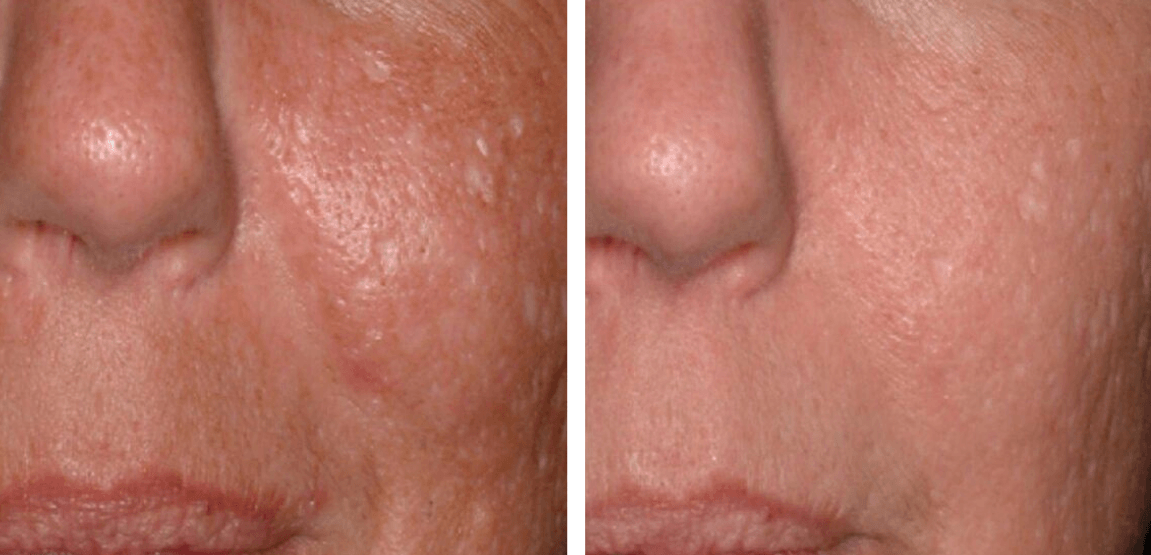 female patient before and after treatment with BOTOX® for moderate crows feet lines
