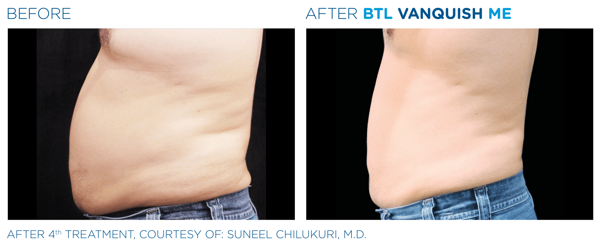 A before and after picture of a man 's stomach