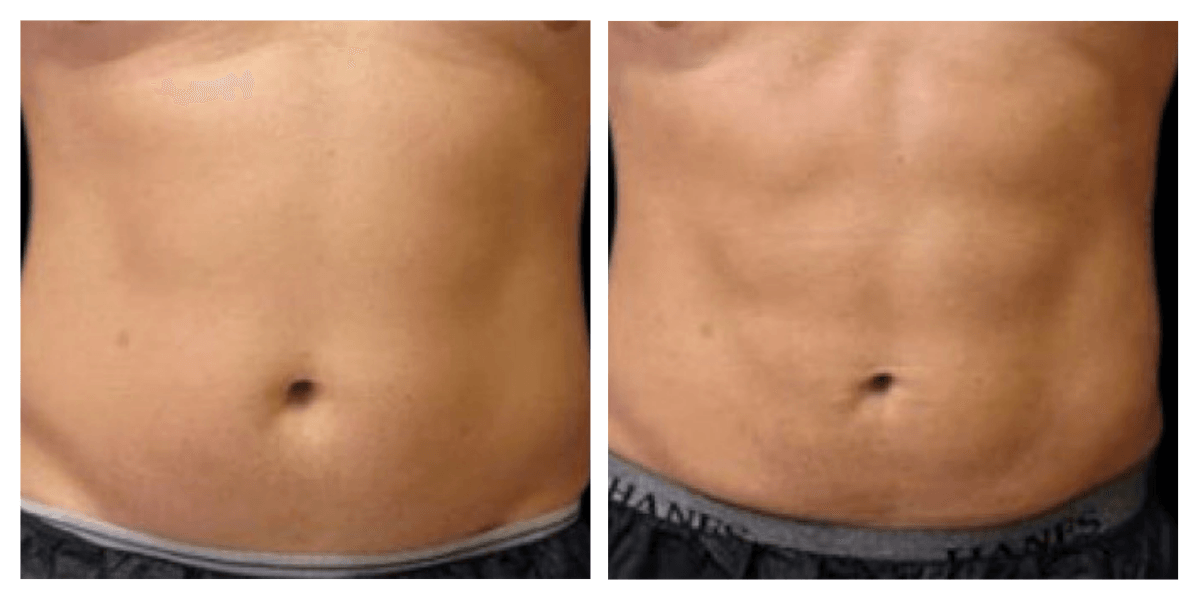 A before and after picture of a man 's stomach.