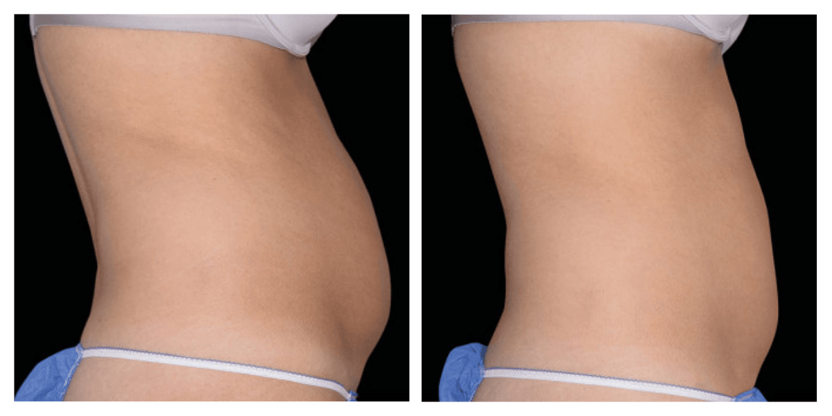 before and after core to floor treatment