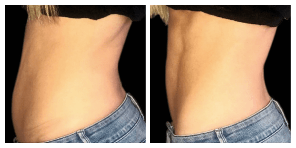 A before and after picture of a woman 's stomach in jeans.