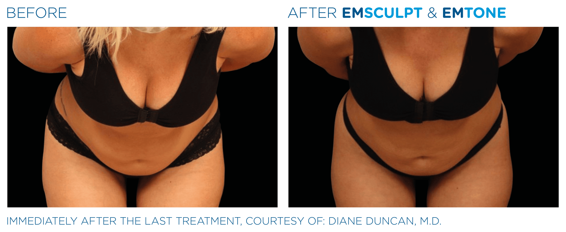 A before and after photo of a woman 's torso and hips.