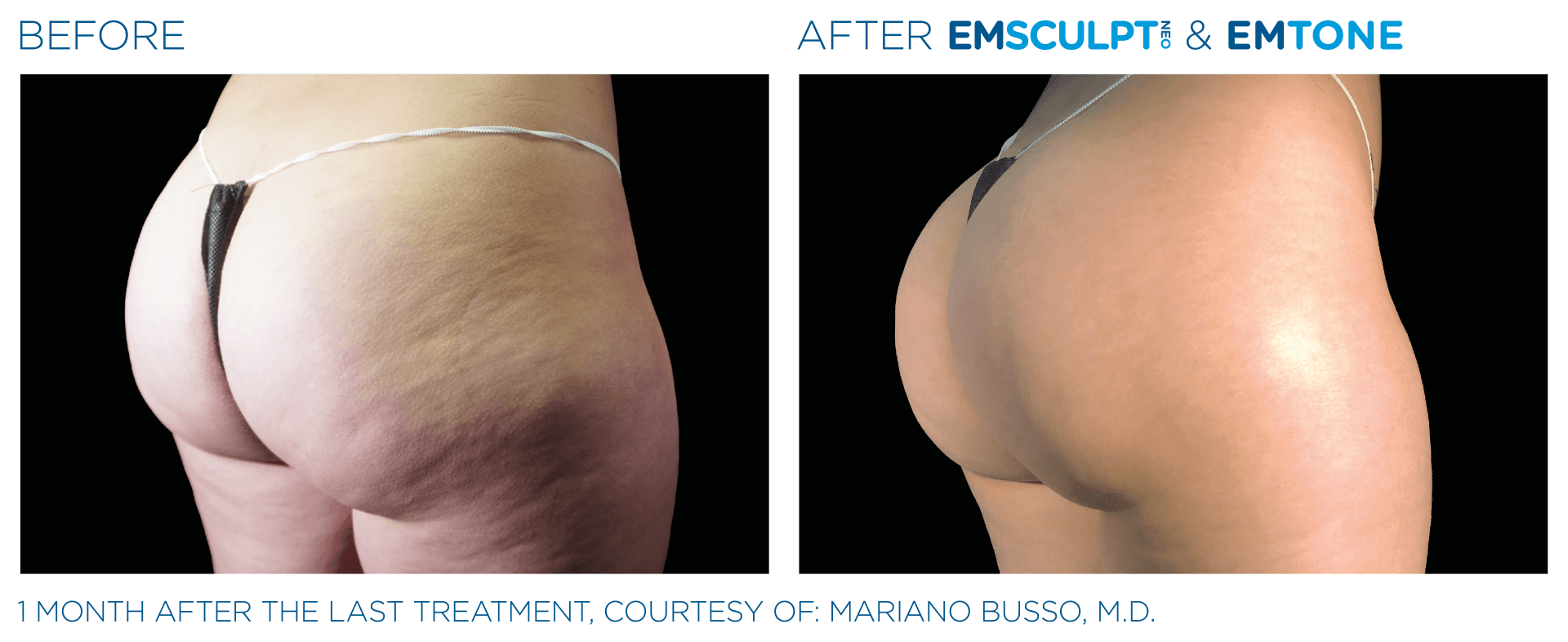 muscle and body sculpting with emsculpt - before and after photo