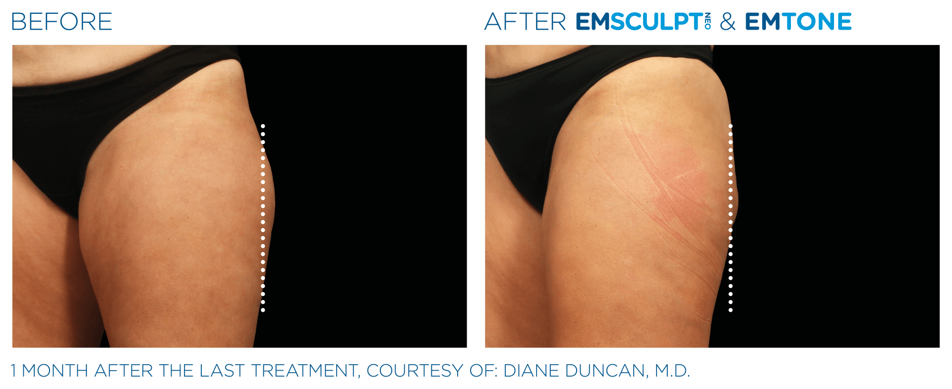 muscle and body sculpting with emsculpt - before and after photo