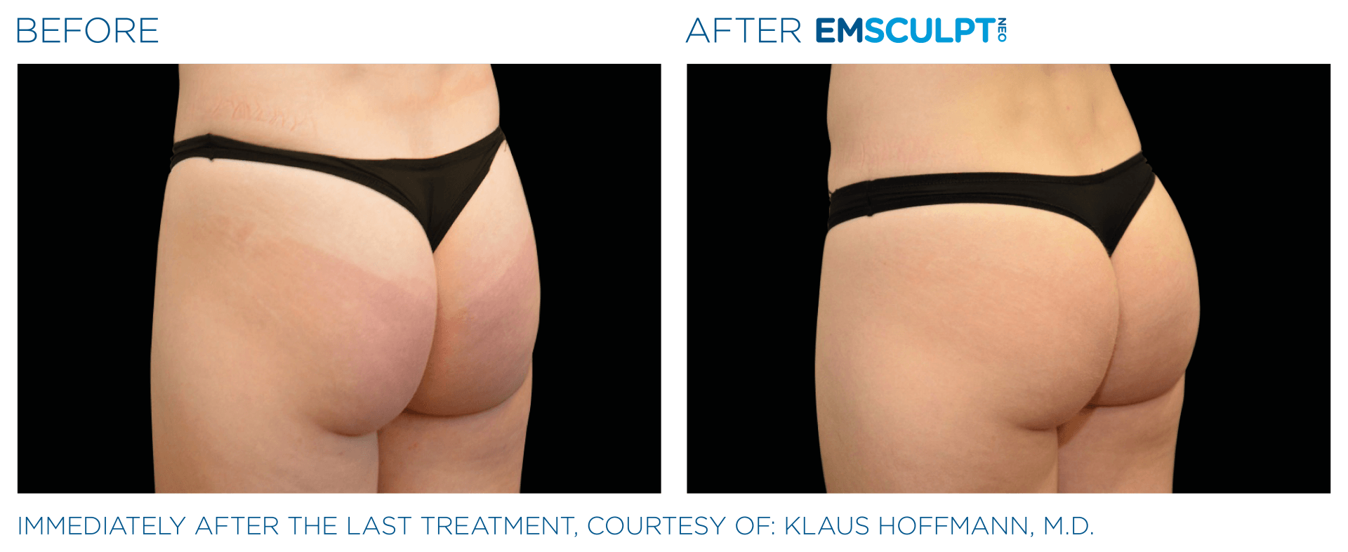 muscle and body sculpting with emscuplt - before and after photos