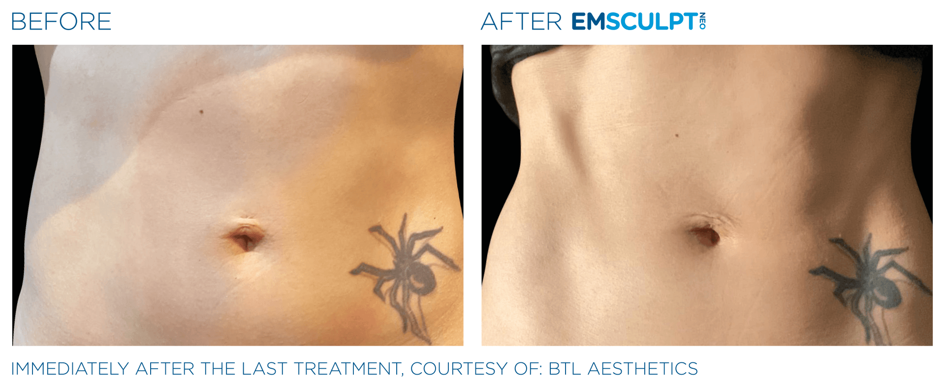 before and after treatment for muscle and body sculpting