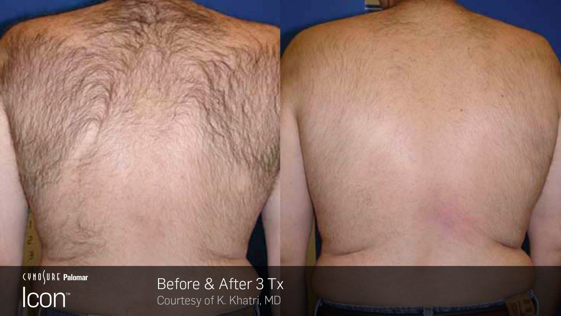A before and after photo of a man 's hairy back