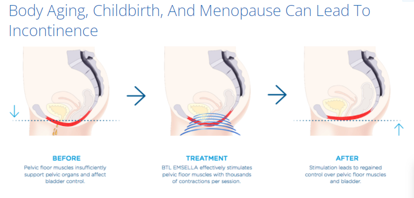 diagram showing incontinence from progressive weakening of female pelvic floor