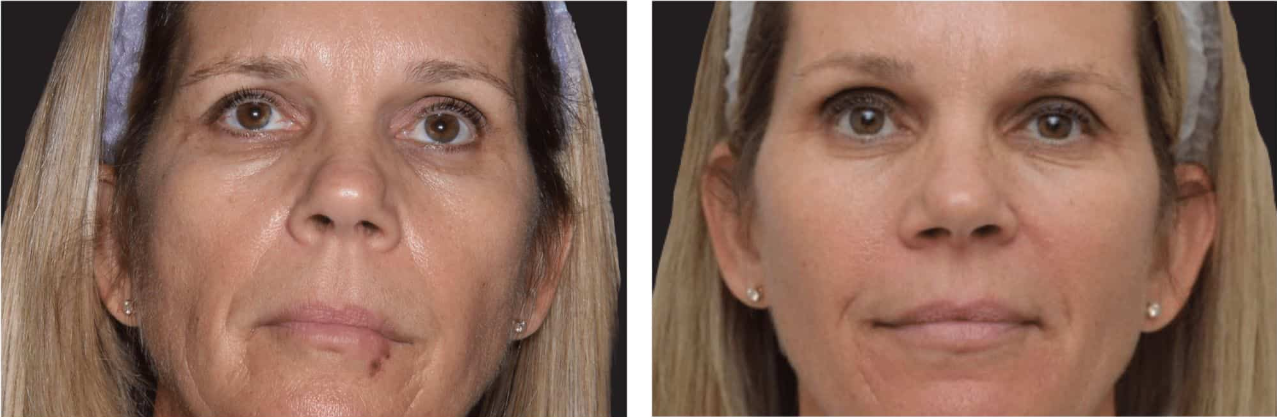 before and after treatment for skin tightening