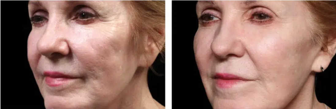 before and after treatment with tempsure for skin tightening