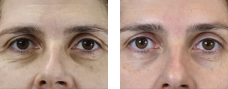 A before and after photo of a woman 's face.