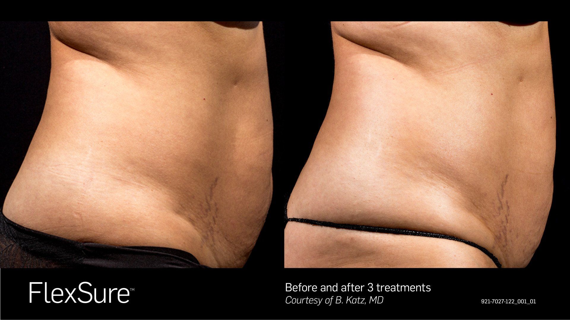before and after body contouring and fat reduction treatments