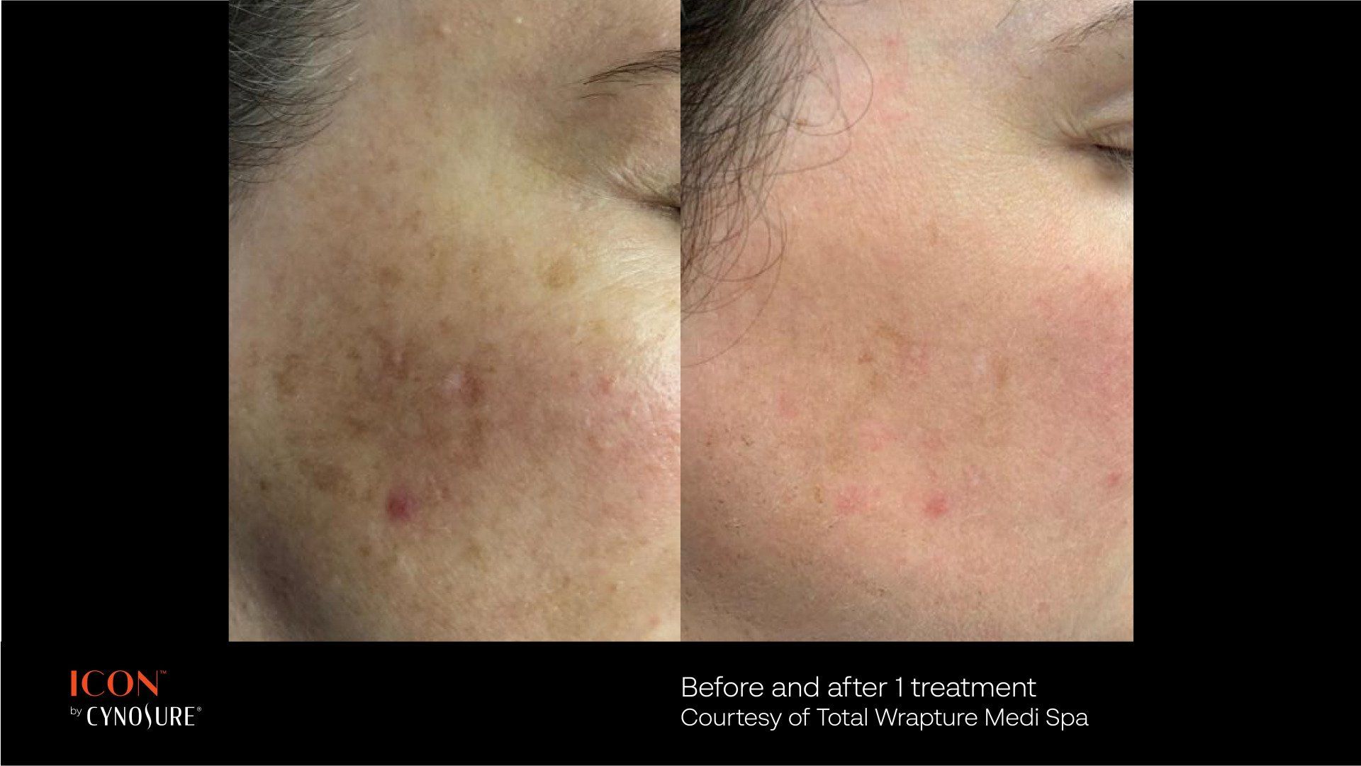 A before and after photo of a woman 's face