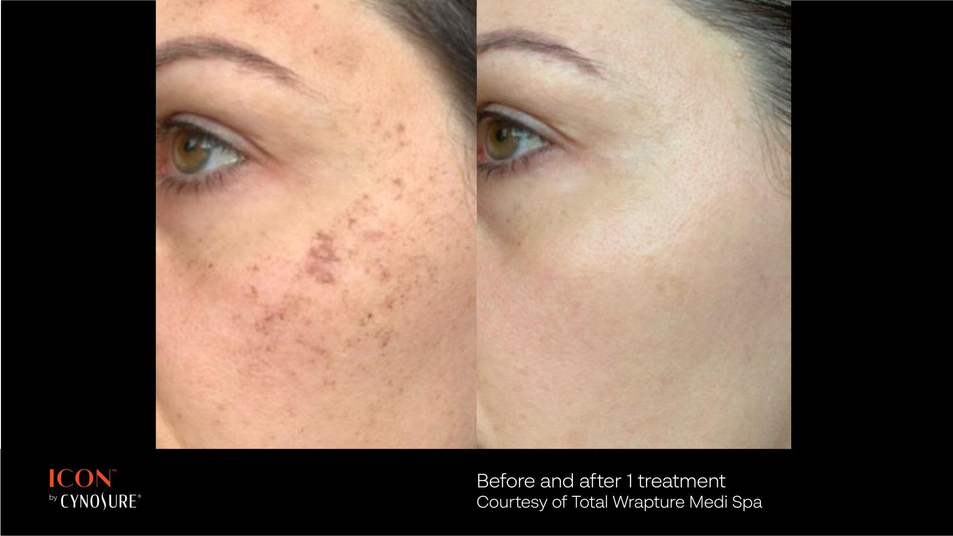 A before and after photo of a woman 's face with freckles