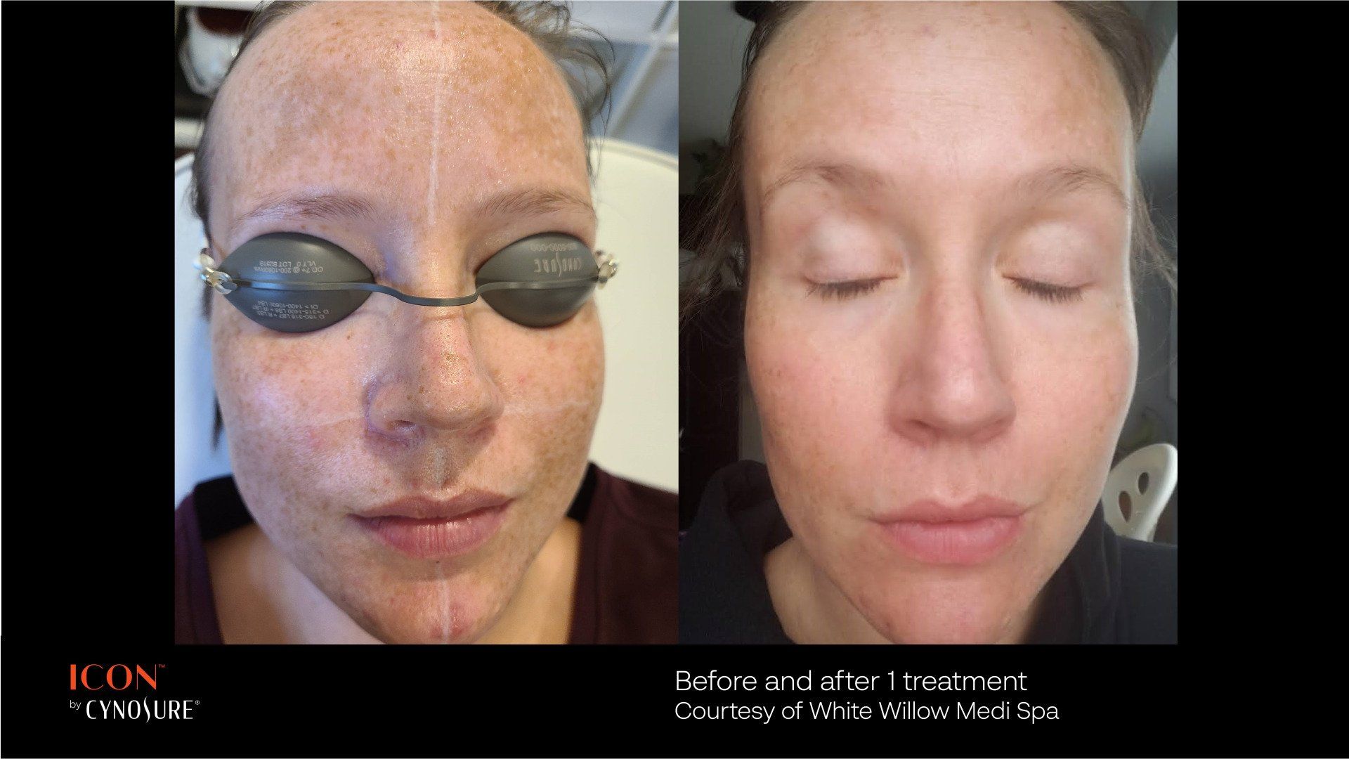 A before and after photo of a woman 's face with glasses on.