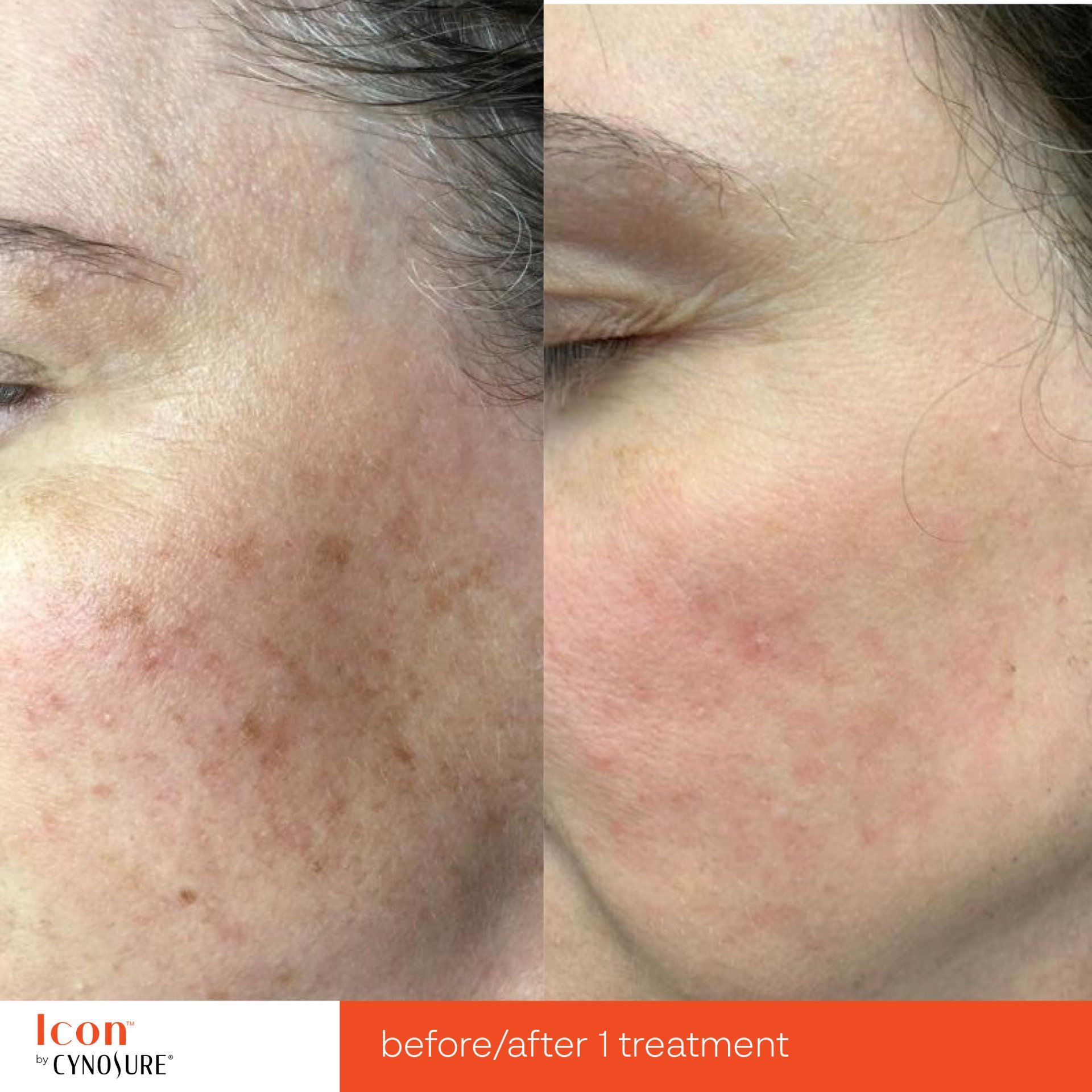 A before and after photo of a woman 's face