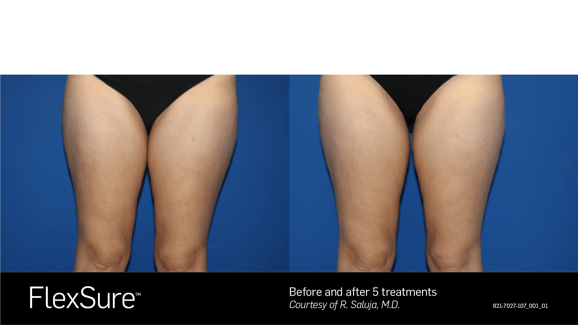 A woman 's legs are shown before and after a flexsure treatment.