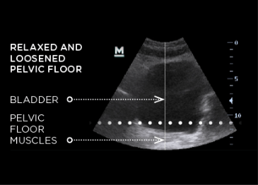 ultrasound before core to floor therapy