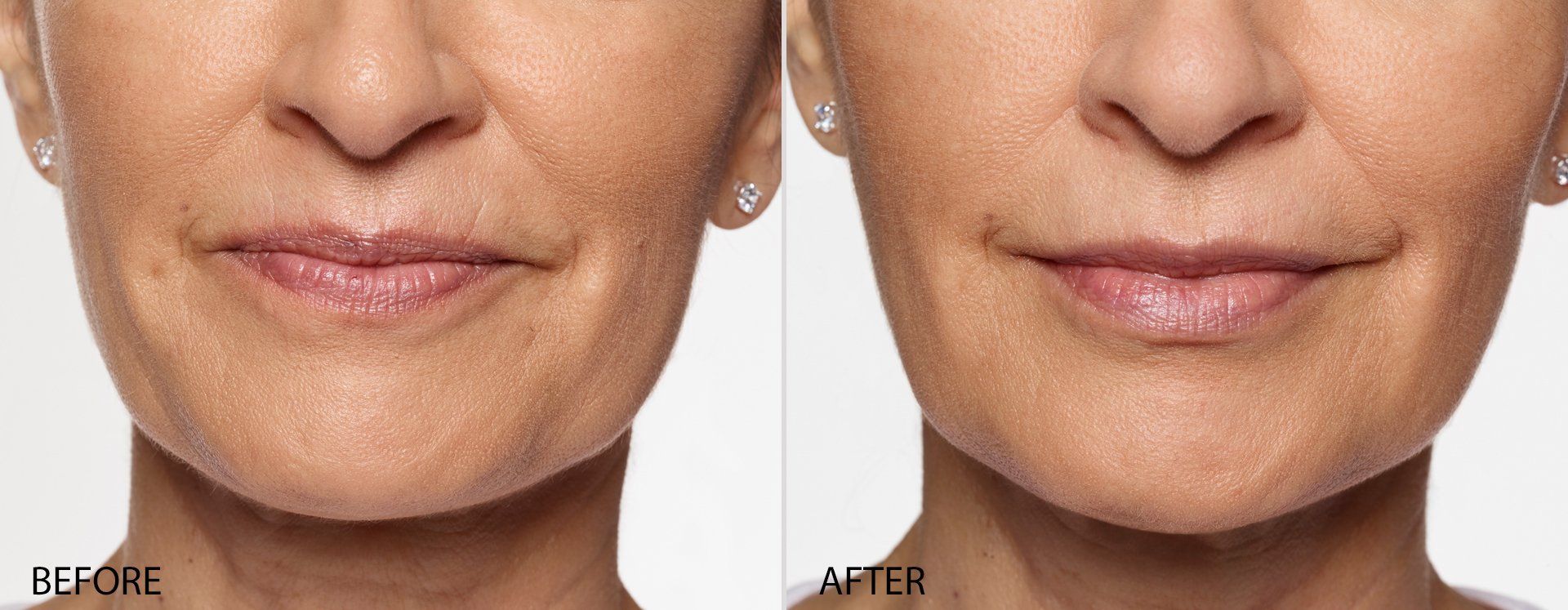 female patient before and after treatment with Restylane fillers
