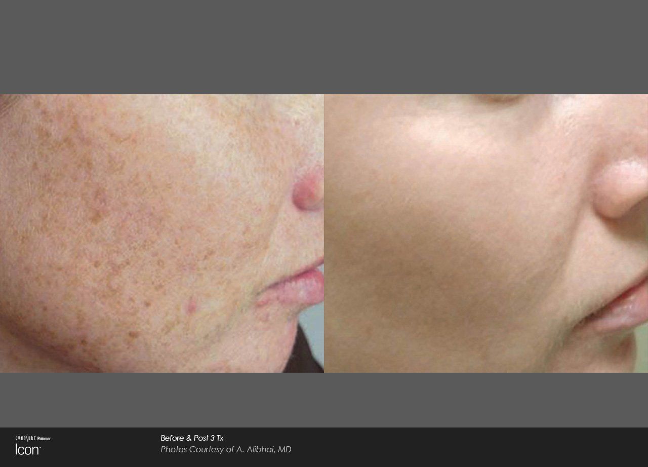 A woman 's face is shown before and after a treatment.