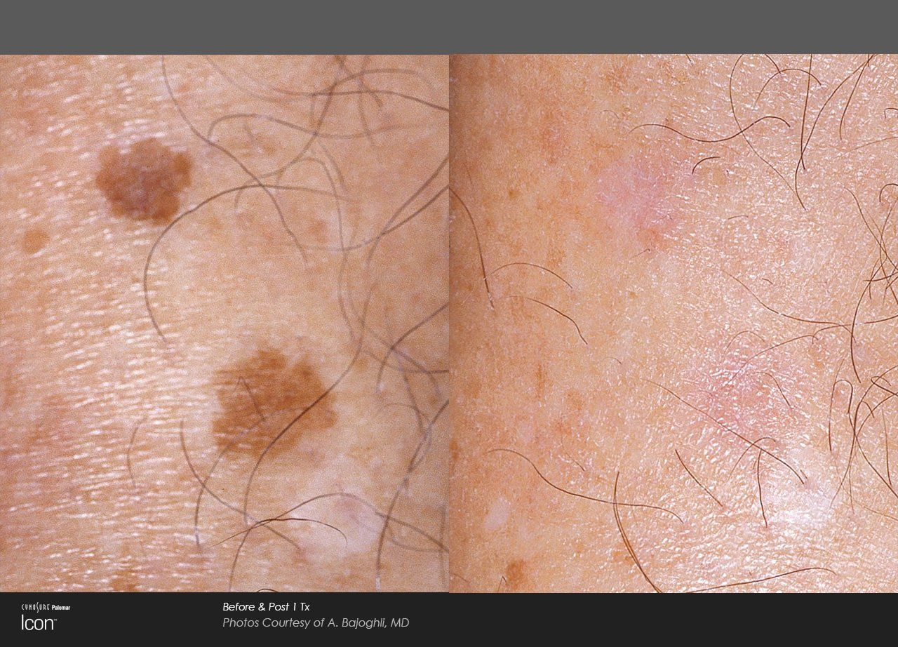 A before and after photo of a person 's skin