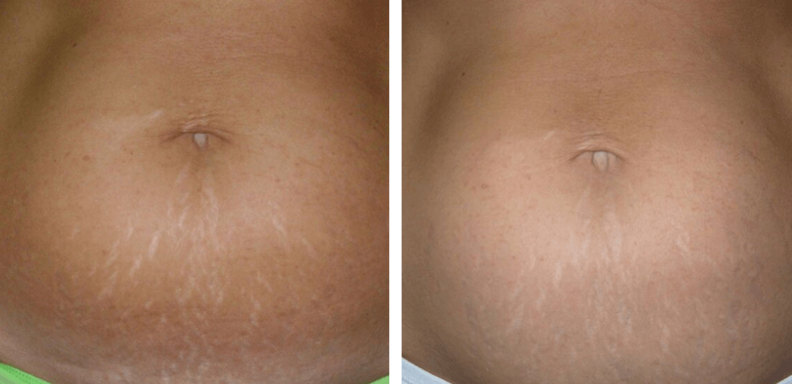 patient before and after treatment with Dysport® for forehead and crows feet lines