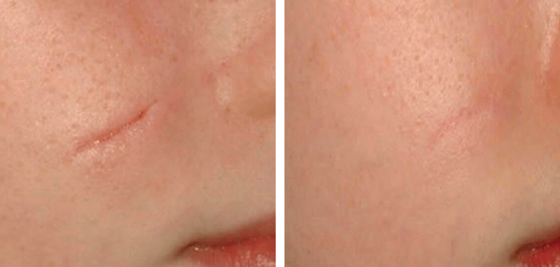 patient before and after treatment with Dysport® for forehead and crows feet lines
