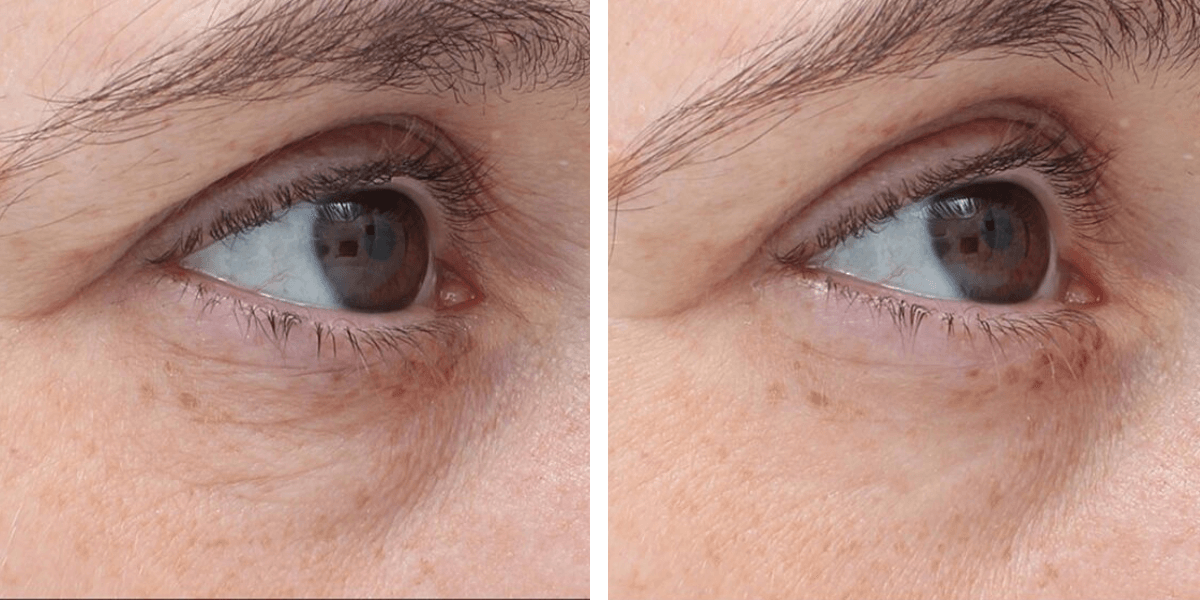 before and after treatment with tempsure for skin tightening