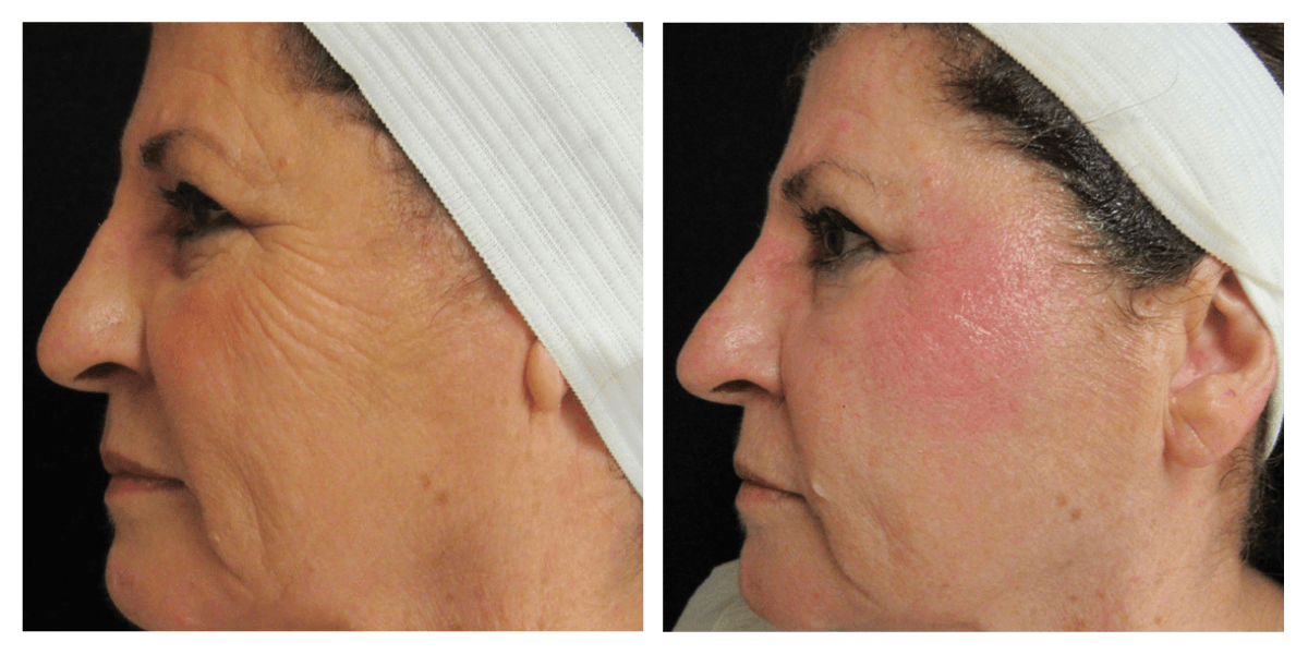 A before and after photo of a woman 's face.