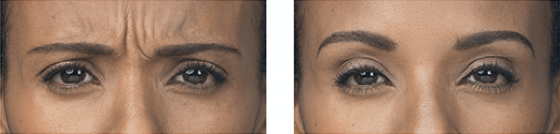 A before and after photo of a woman 's forehead and eyebrows.