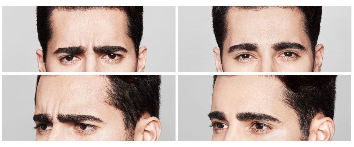 A man 's forehead is shown in four different angles.