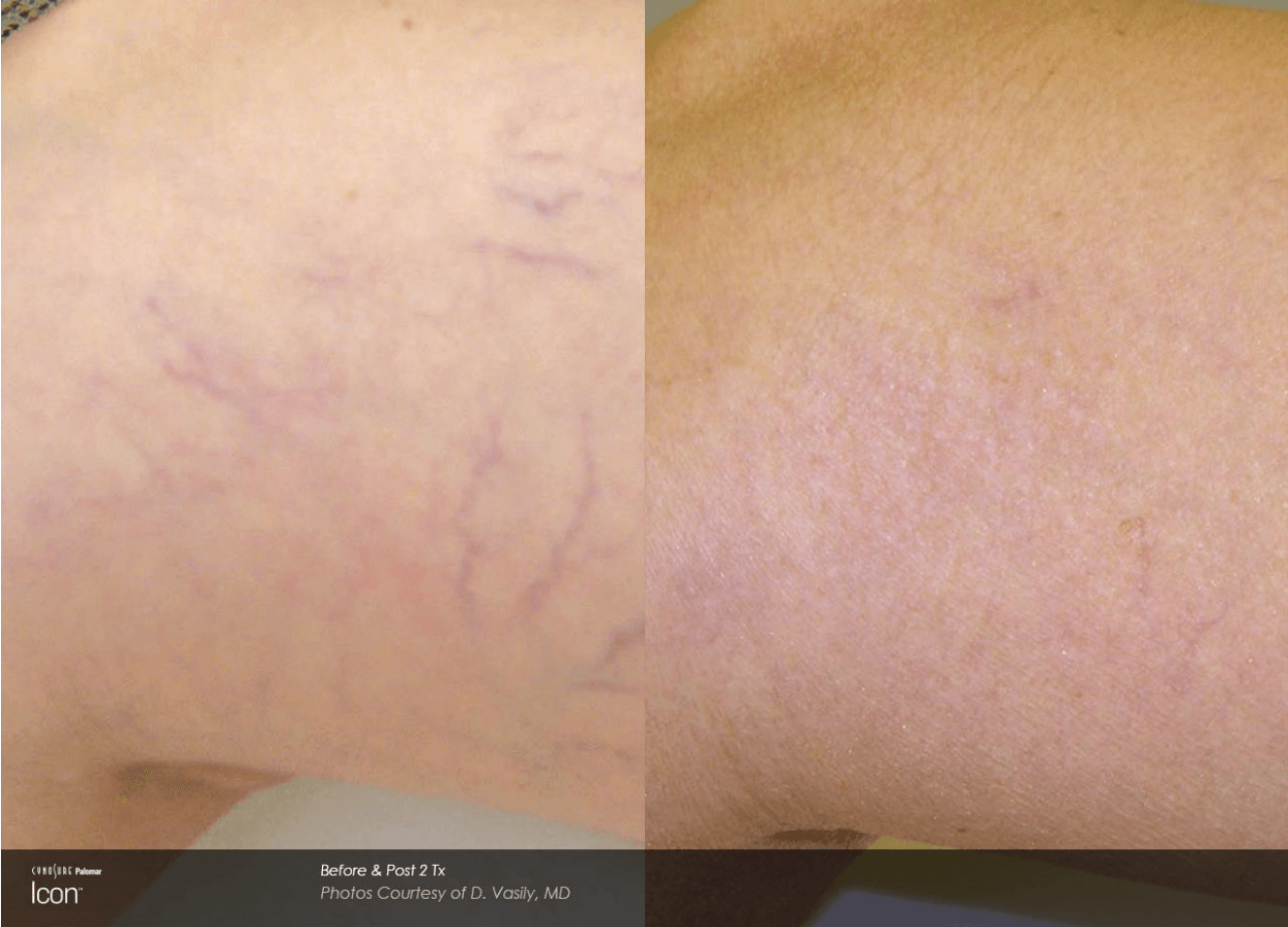 female patient before and after treatment with BOTOX® for moderate crows feet lines