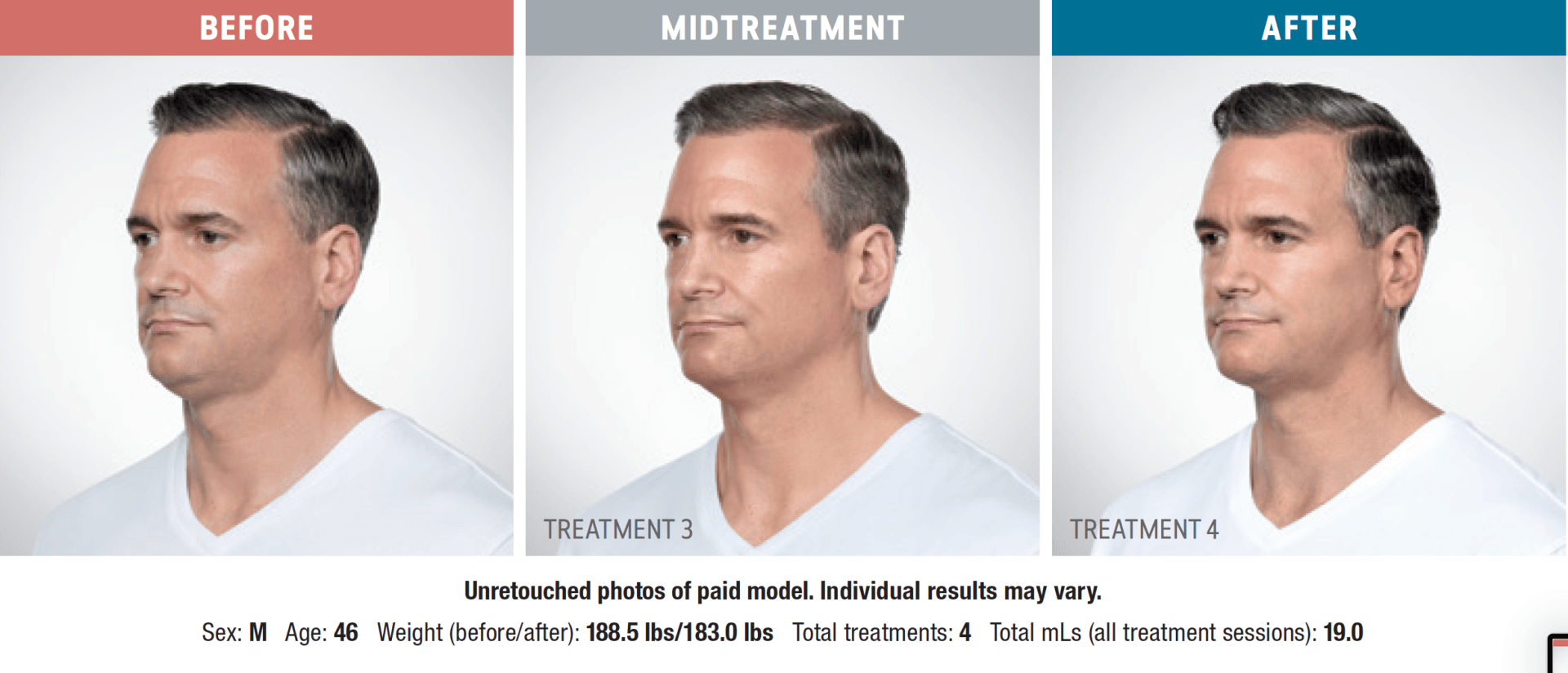 A man is shown before and after a neck lift.