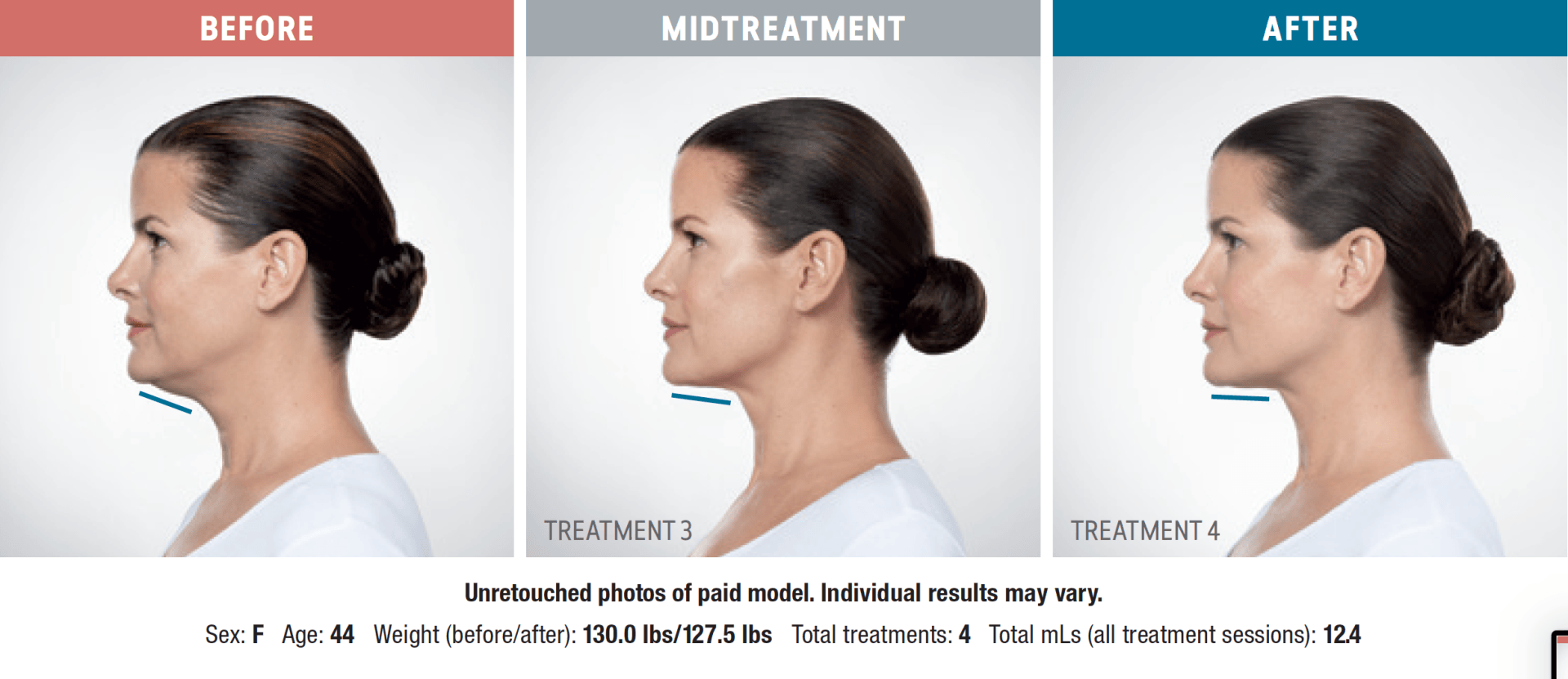 A woman 's face is shown before and after a procedure.