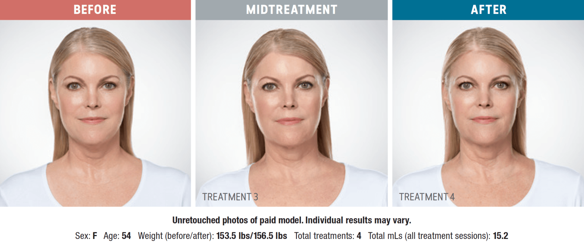 patient before and after treatment with Kybella®