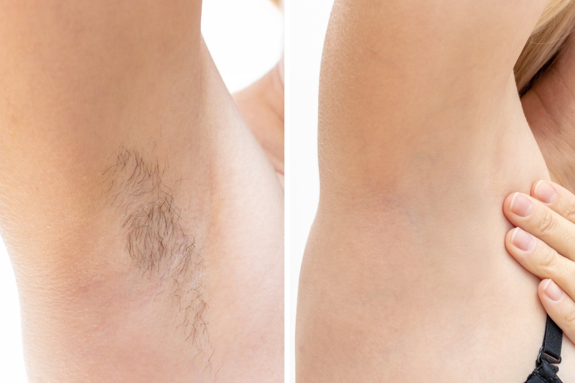laser hair removal before and after