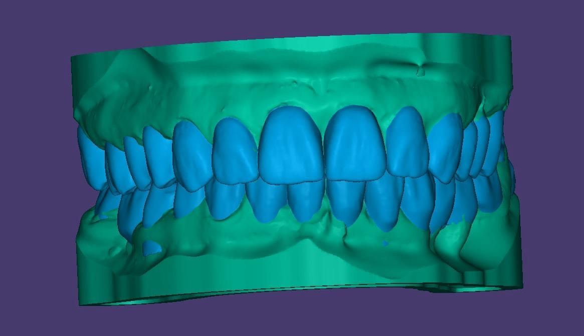 Un dentista está trabajando en un modelo de los dientes de una persona.