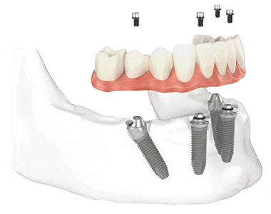 A computer generated image of a person 's teeth with dental implants.