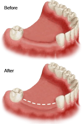 A before and after picture of a person 's teeth